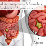 Abdominal Actinomycosis