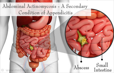 Abdominal Actinomycosis