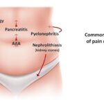 Abdominal Colic