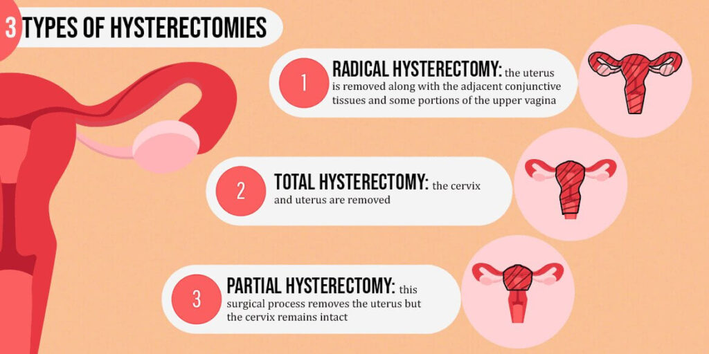 Abdominal Hysterectomy Infection Prevention