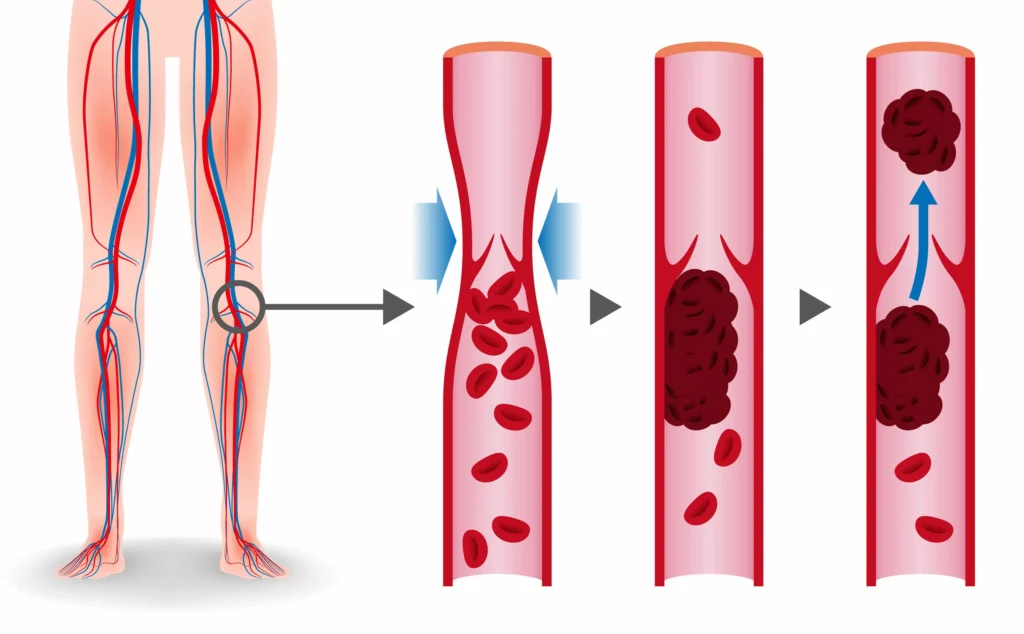 Abdominal Surgery Deep Vein Thrombosis Prevention