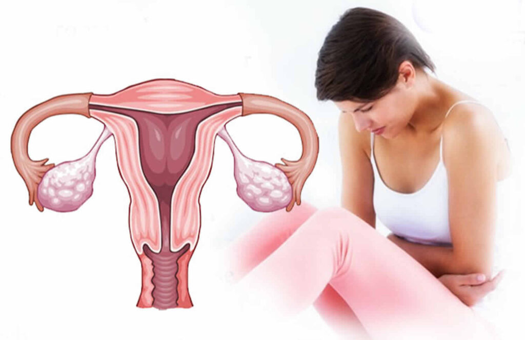 Abnormal Uterine Bleeding