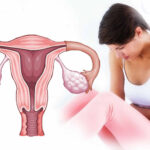 Abnormal Uterine Bleeding