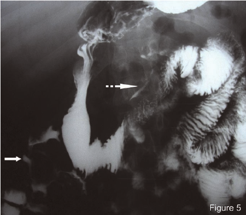 Acceleration of Barium Meal Transit Through the Small Bowel