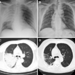 Acinetobacter Pneumonia