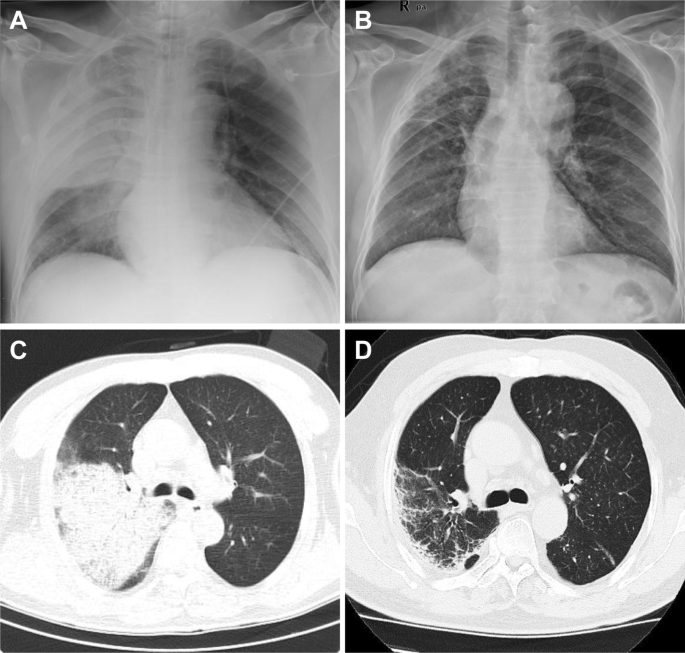 Acinetobacter Pneumonia