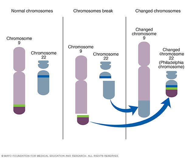 accelerated phase philadelphia chromosome positive chronic myelocytic leukemia