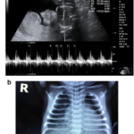 acceleration of fetal lung maturation