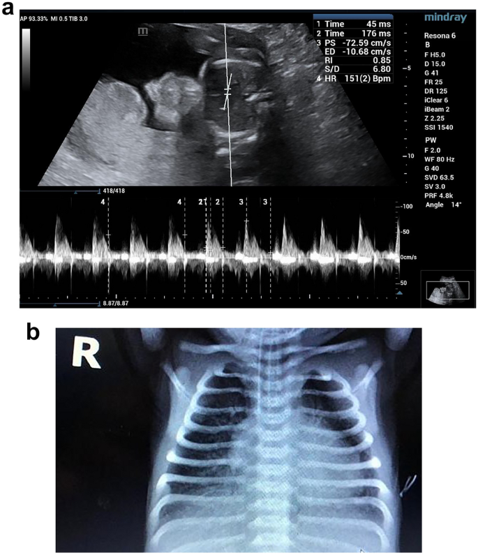 acceleration of fetal lung maturation