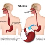 achalasia of esophagus