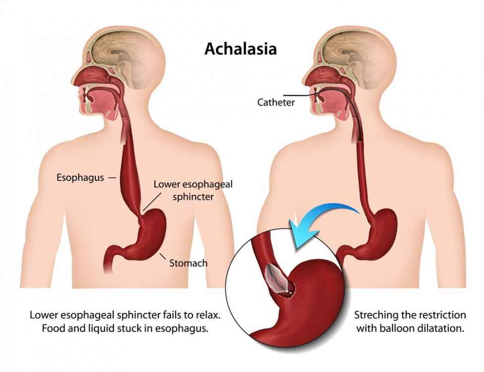 achalasia of esophagus