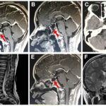 acinetobacter meningitis