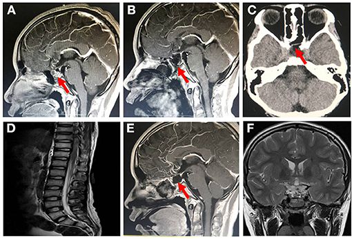 acinetobacter meningitis