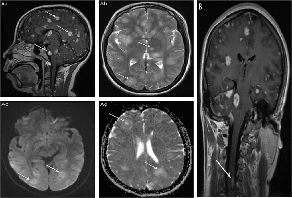 Acquired Immunodeficiency Syndrome With Toxoplasmosis