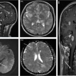 Acquired Immunodeficiency Syndrome With Toxoplasmosis