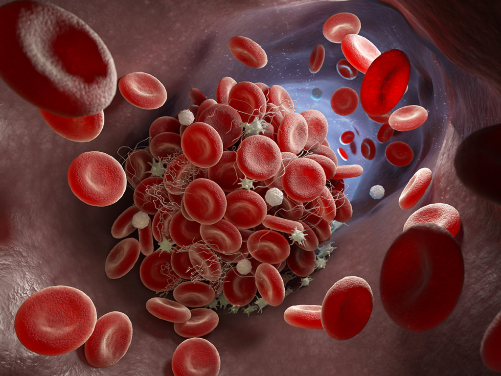 Acquired Thrombocytopenia