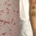 Acquired Thrombotic Thrombocytopenic Purpura