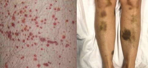 Acquired Thrombotic Thrombocytopenic Purpura