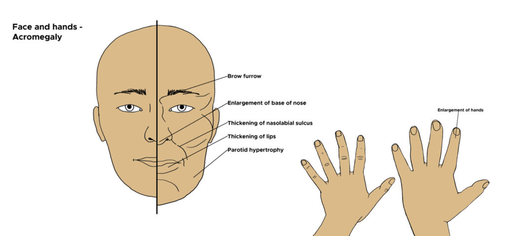 Acromegaly