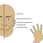 Acromegaly