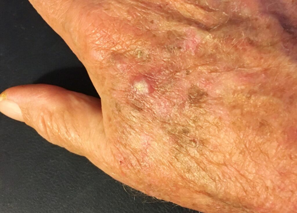 Actinic Keratosis