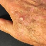 Actinic Keratosis