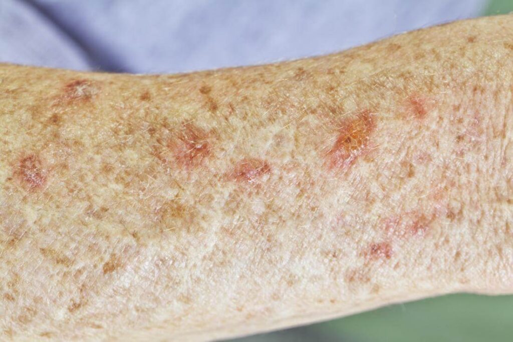 Actinic Keratosis Of The Upper Extremity