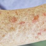 Actinic Keratosis Of The Upper Extremity