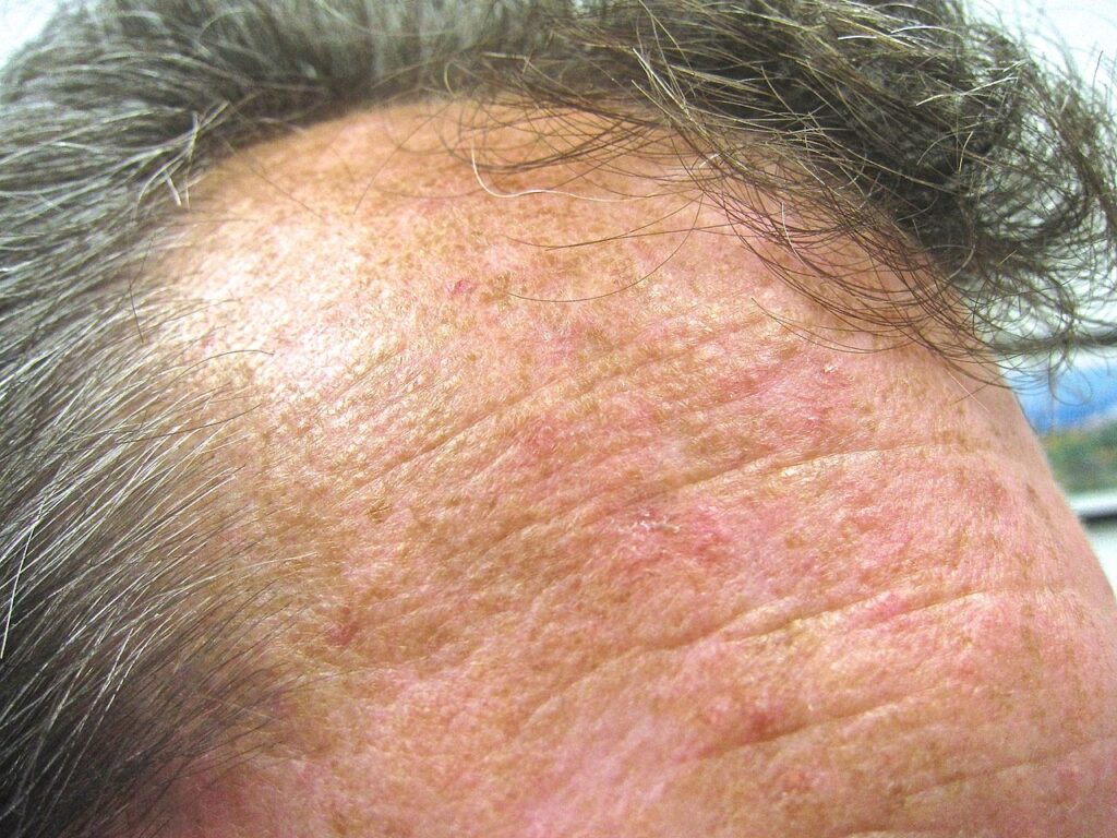 Actinic Keratosis On The Face Or Scalp