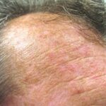 Actinic Keratosis On The Face Or Scalp