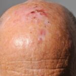 Actinic Keratosis On The Trunk Or Extremities