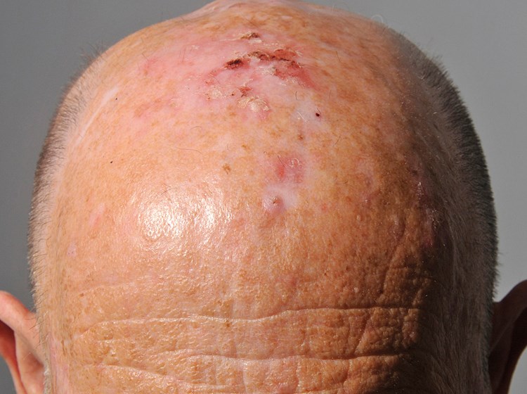 Actinic Keratosis On The Trunk Or Extremities