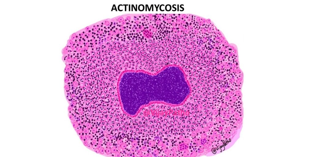 Actinomycosis