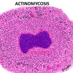 Actinomycosis