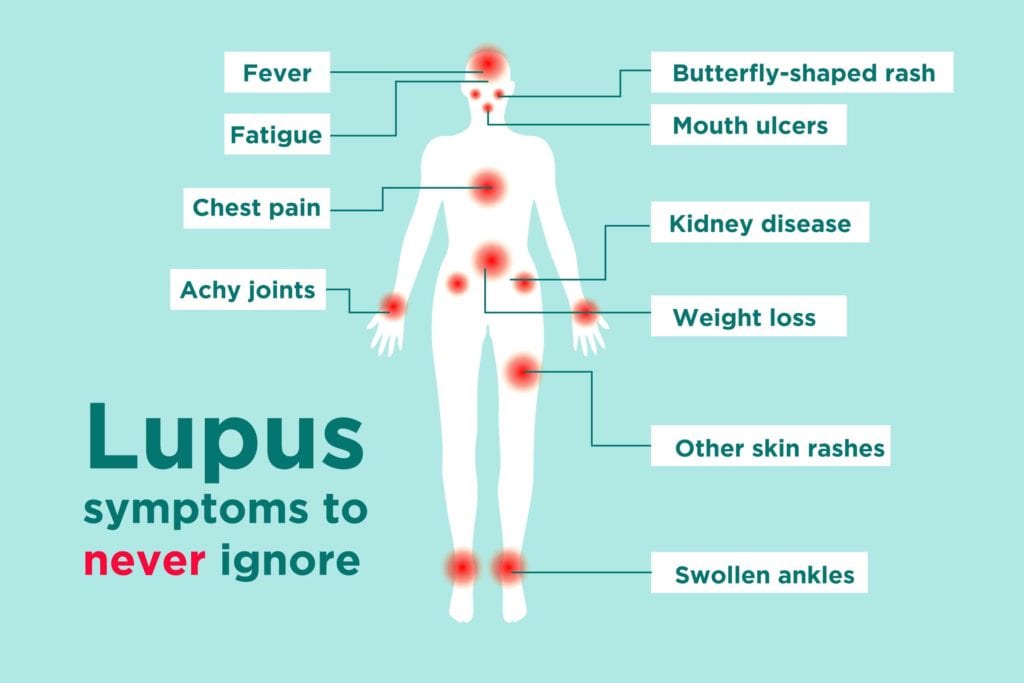 Active Lupus Nephritis