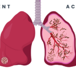 Active Tuberculosis