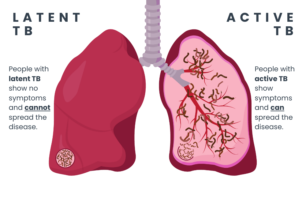 Active Tuberculosis