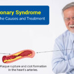 Acute Coronary Syndrome