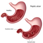 Acute Duodenal Ulcer with Hemorrhage