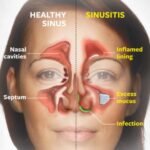 Acute E coli Bacterial Sinusitis