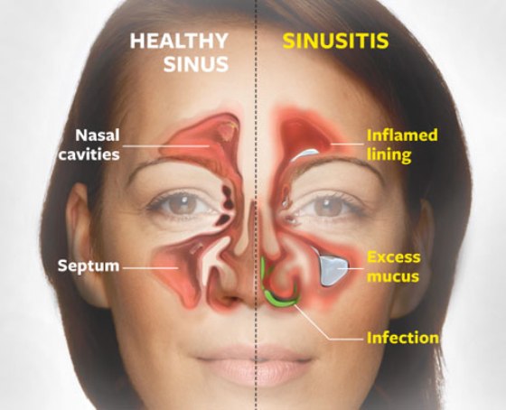 Acute E coli Bacterial Sinusitis