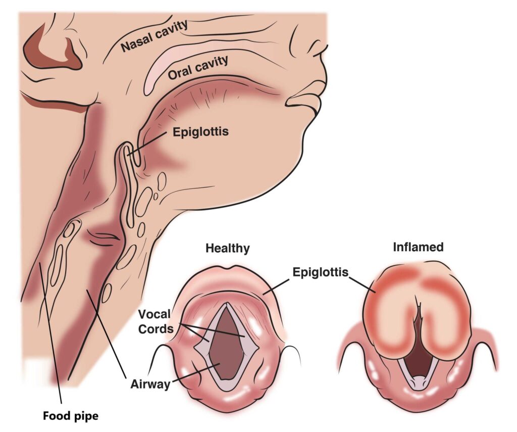 Acute Epiglottitis