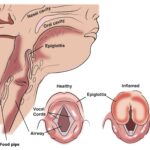 Acute Epiglottitis