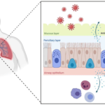 Acute Exacerbation of Obstructive Chronic Bronchitis Due to H flu