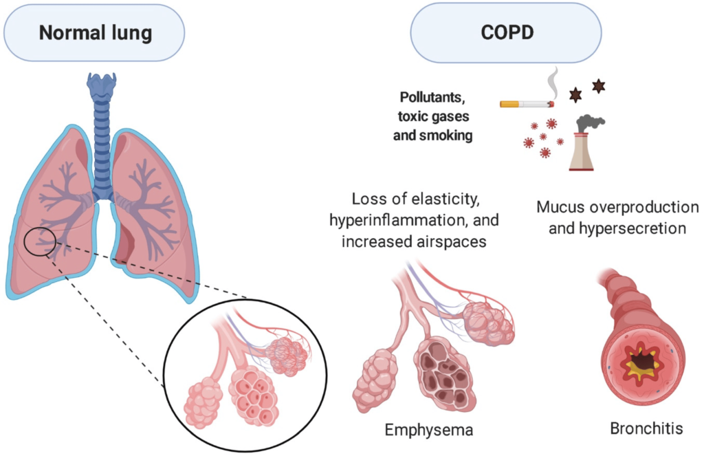 Acute Exacerbation of Obstructive Chronic Bronchitis by M. catarrhalis