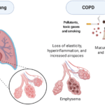 Acute Exacerbation of Obstructive Chronic Bronchitis by M. catarrhalis