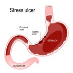 Acute Gastric Ulcer with Hemorrhage