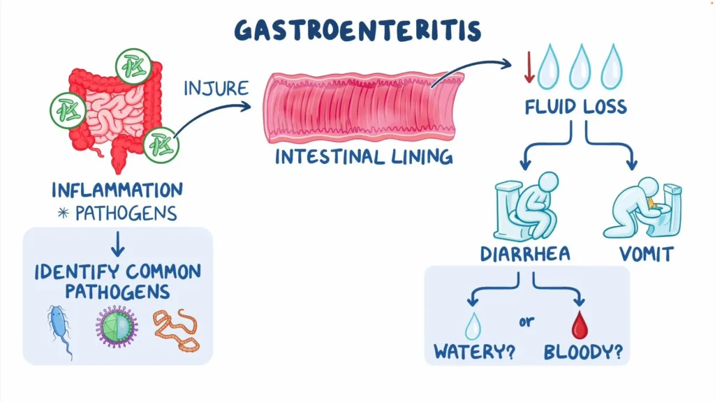 Acute Gastroenteritis-Related Vomiting in Pediatrics