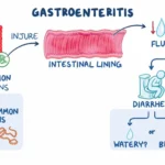 Acute Gastroenteritis-Related Vomiting in Pediatrics