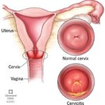 Acute Gonococcal Cervicitis